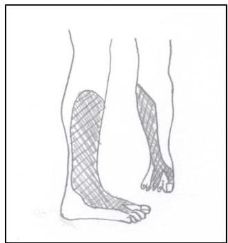 종아리 외측과 발등의 감각 저하 부위를 빗금으로 표시한 모식도. 빗금 친 영역이 종아리 바깥쪽 하단에서 시작하여 발등 전체로 퍼져 있으나, 첫 번째와 두 번째 발가락 사이 공간은 제외되어 있음.