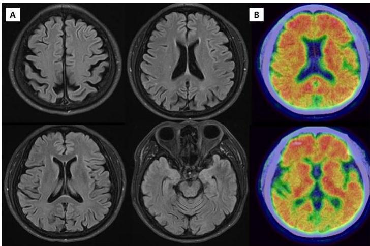 뇌 MRI 및 Amyloid PET
