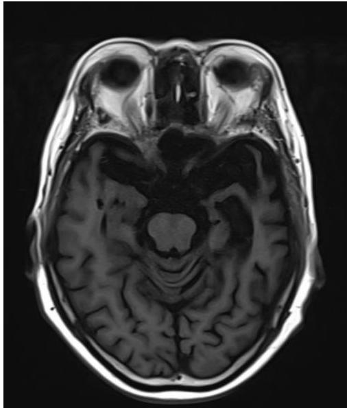 뇌 MRI T1 강조 축상면 영상. 좌측 전측두엽(anterior temporal lobe) 부위의 심한 뇌회 위축과 측뇌실 하각의 확장이 관찰됨.