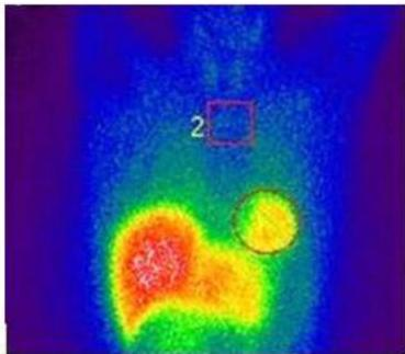 MIBG Scintigraphy